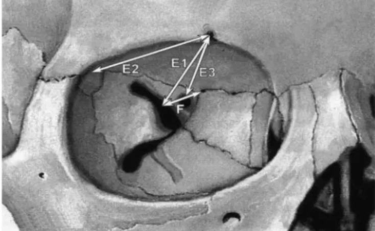 Fig. 3 Measurements of the superior orbital wall. E1, Distance from the supraorbital foramen to the midpoint of the superior orbital ﬁssure; E2, distance from the supraorbital foramen to the midpoint of the fossa for the lacrimal gland; E3, distance from t