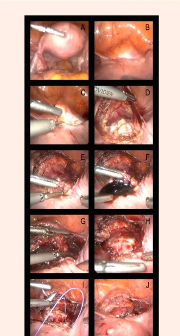 Figure 2: Laparoscopic excision and repair of the cesarean scar defect. 