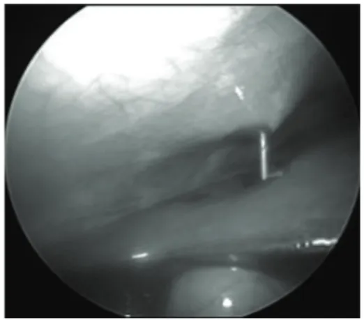 Figure 2: Chiba needle is inserted into the gallbladder via transpass- transpass-ing the liver under direct telescopic vision.