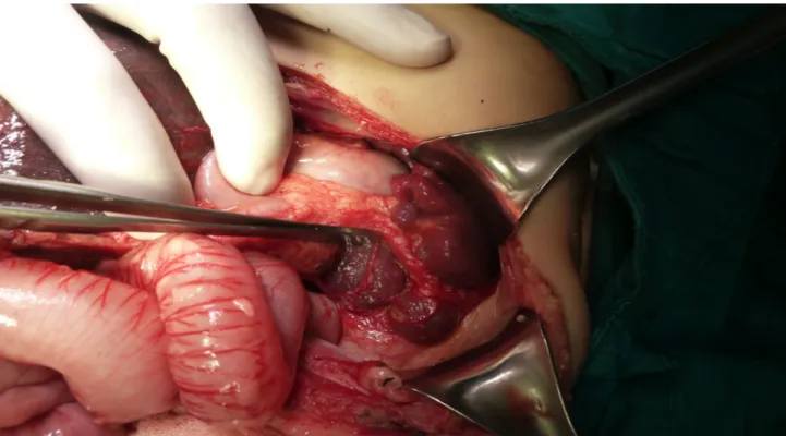 Figure 1. Polysplenia of patient 4.