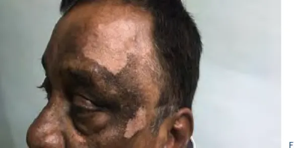 Fig. 1. Depigmented skin lesions