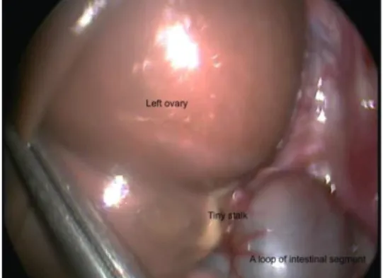 Figure 2: Twisted right ovarian cyst.