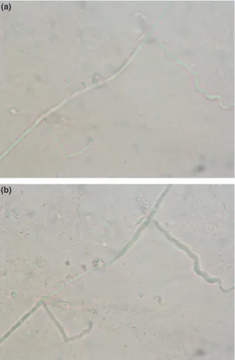 Figure 1 On KOH examination, hyphae are seen as branching thread-like structures which are brighter than the background and slightly greenish ( 9400)
