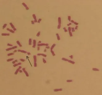 Figure 1.  Chromatid  type  fracture  in  human  peripheral  lymphocytes  treated  with  Delphinidin  chloride  and MMC (x1000) (100 µM, 48h, ♂) 