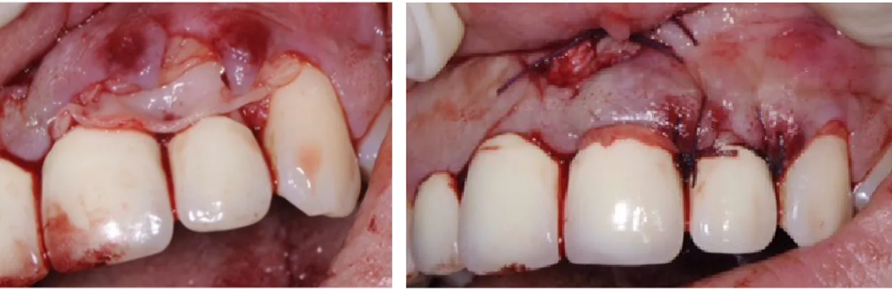 Figure 2.  PRF membrane on the exposed root surface -  Figure 3.  Interdental sutures stabilizing the membrane and the flap