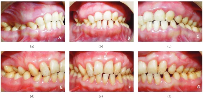 Figure 2: Initial appearance of 19-year-old patient presents more mild gingival enlargements comparing with her younger sibling ((a), (b), and (c))