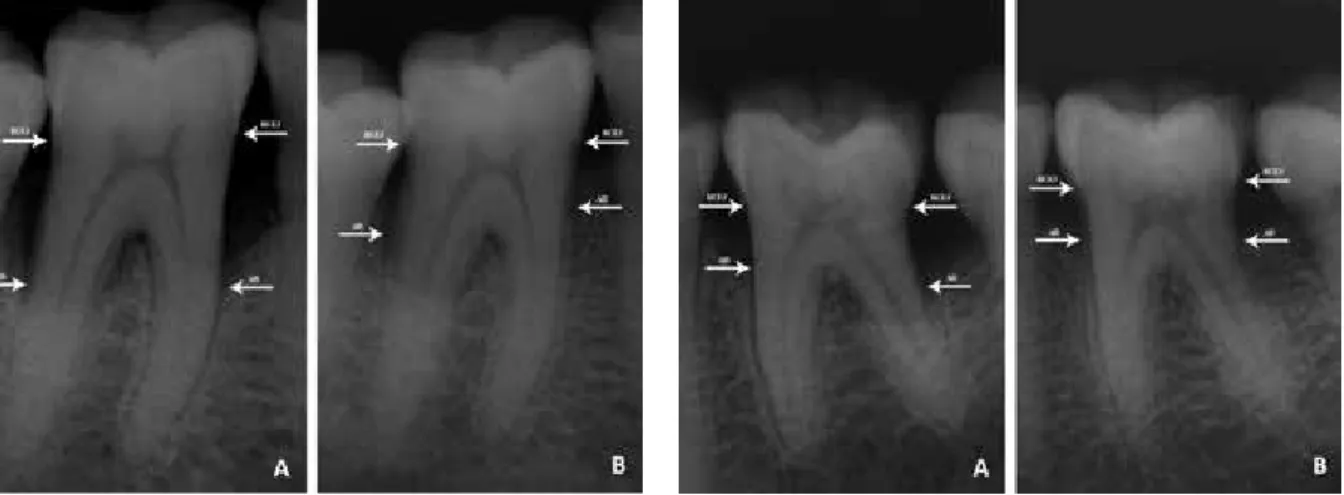 Figure 1. Radiological appearances of the intraosseous defect.  A. Before treatment of ACB B