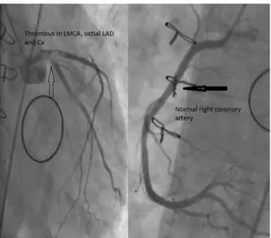 Figure 1. Massive thrombus in LMCA extending into the LAD and CX os- os-tia with normal RCA