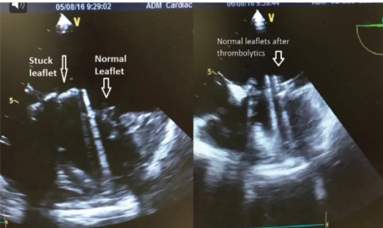 Figure 3. Stuck mitral leaflet on the left and normal leaflet motion after  thrombolytics