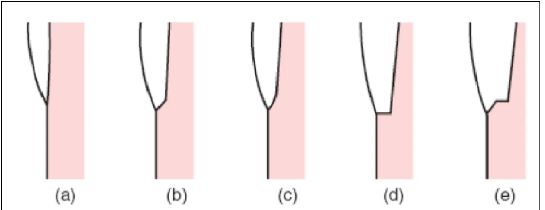 ġekil 2.8: Diş kesimi basamak çeşitleri (a) Bıçak ağzı, (b) Bevel,(c) Chamfer, (d)  Shoulder, (e) Bevel‘lı shoulder 