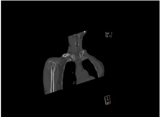 Figure 2: CT view of the same patients preoperatively.