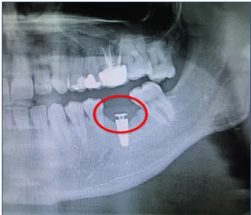 Figure 2. Pre-operative view of the radiograph A crestal incision was made over the implant  side,  mobilized  screw  was  removed  and  intraoral  drainage  was  performed