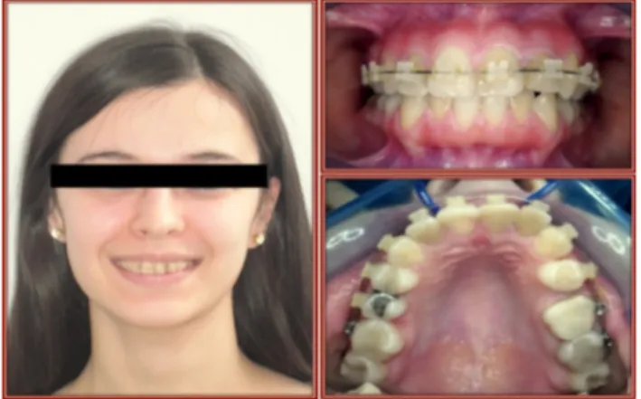 Figure 1 OPG Before Orthodontic Treatment Figure 2 Case Photos (Before) orthodontic treatment