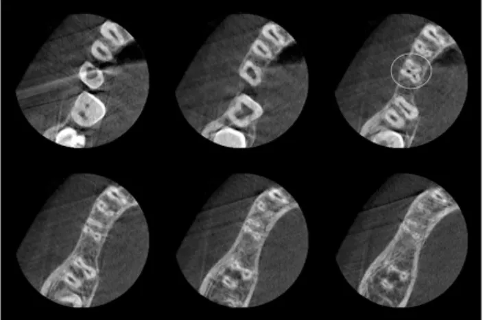 Figure 2 CBCT  axial  scan  of  mandibular  second premolar with three canals.