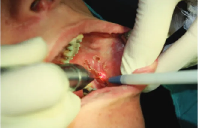 Figure 2. Excision of the lesion with diode  laser