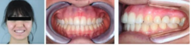 Figure 2. The photographic records before  upper labial frenectomy and after healing.