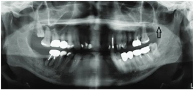 Figure 1: Panoramic view of the broken  segment