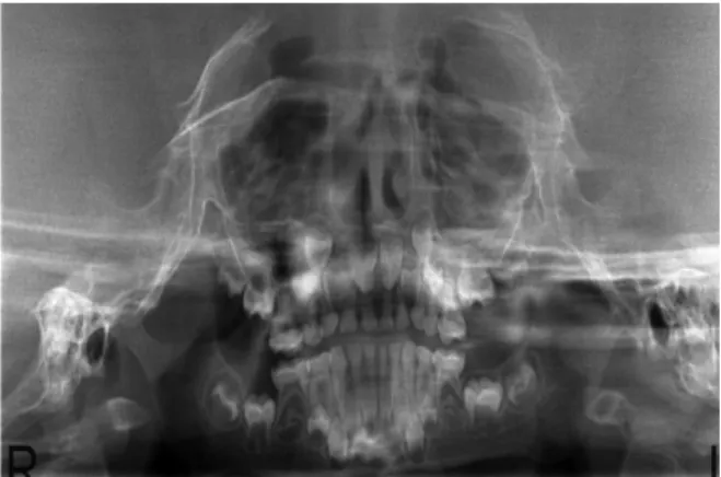 Figure 5.  Panoramic X-Ray of the patient. The parents were instructed on the dietary  intake and also informed on misconceptions  of  feeding  during  the  night