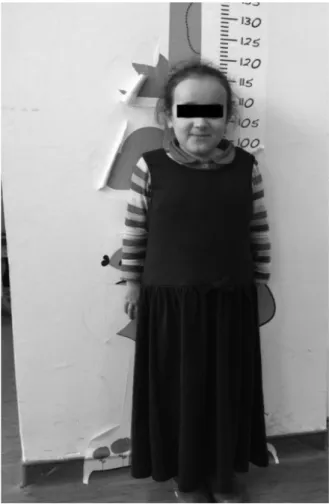 Figure 1: A 11-year-old girl with LS The  patient  applied  to  Marmara  University  Faculty of Dentistry for the treatments of  decayed teeth