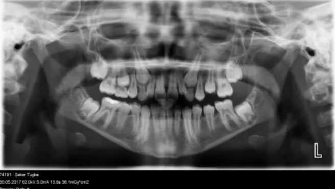 Figure 2 : Panoramic  X-ray of the patient  The caries of permanent molars was the  enamel caries that composite (Charisma  smart) materials were used for the restorations
