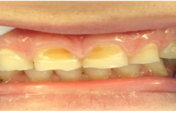 Figure 1. Initial appearance of the maxillary central teeth with erosive lesions and worn incisal edges
