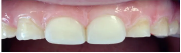 Figure 2. The final view of the maxillary central teeth restored with direct composite laminate veneers