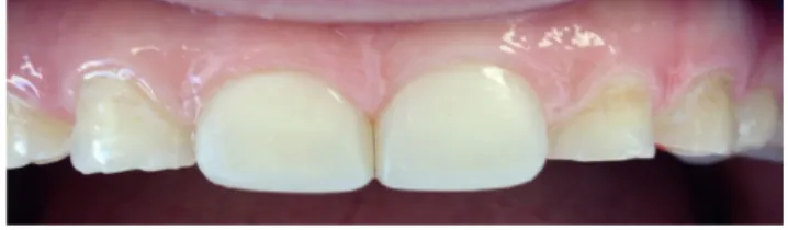 Figure 2. The final view of the maxillary central teeth restored with direct composite laminate veneers