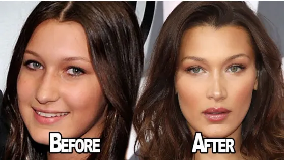 Şekil 5: Bella Hadid Önce ve Sonrası   Kaynak: www.reddit.com, 2019 