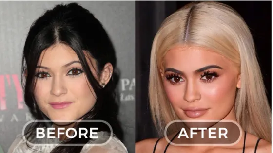 Şekil 6: Kylie Jenner Önce ve Sonrası   Kaynak: www.boredyawn.com, 2019