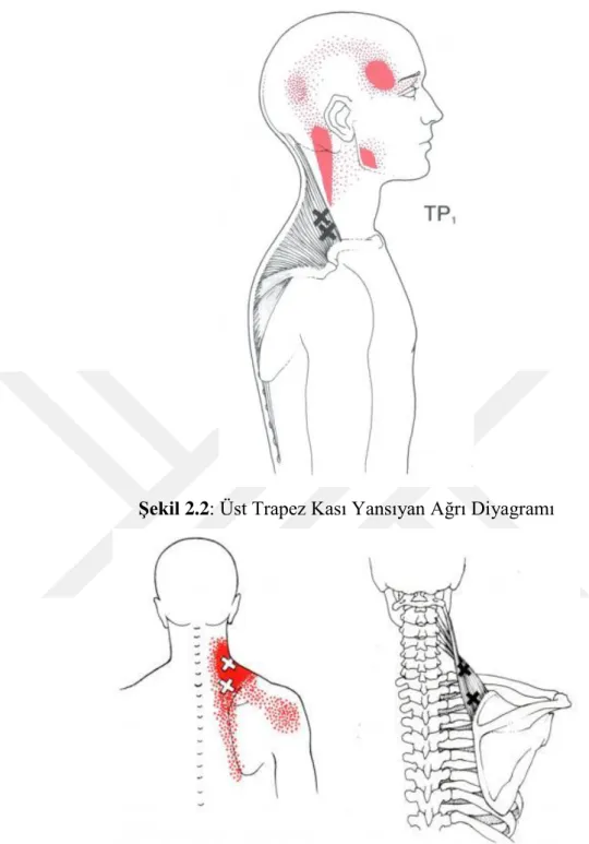 Şekil 2.2: Üst Trapez Kası Yansıyan Ağrı Diyagramı 