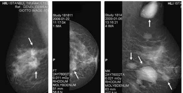 Fig. 6. Mammograms from the I.U. database with annotated masses: the ﬁrst and second mammograms have malignant masses and the third one has benign masses.