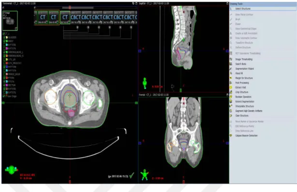 Şekil 3.3: Varian Eclipse ™  Konturlama Sistemi  3.2.3 Üç boyutlu konformal radyoterapi (3D-CRT)  tedavi planları 