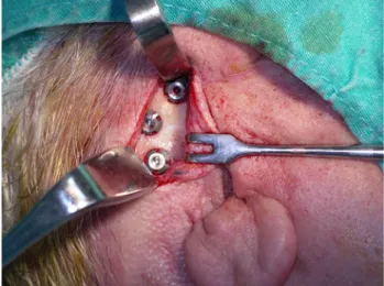 Fig. 2 Partial auricular defect and the dolder bar placed in a passive fit