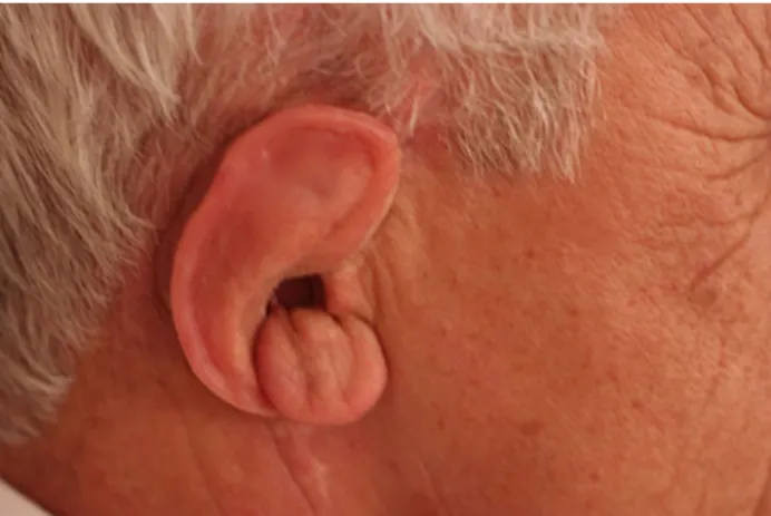 Fig. 5 Partial external-ear defect and the dolder bar placed in a passive fit