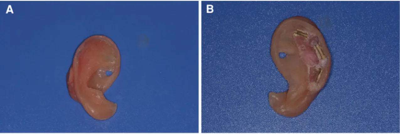 Fig. 6 Silicone prosthesis. a Outer surface of the prosthesis. b Inner surface of the prosthesis