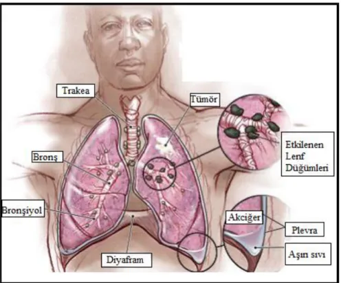 ġekil 2.1: Akciğer kanseri   10 