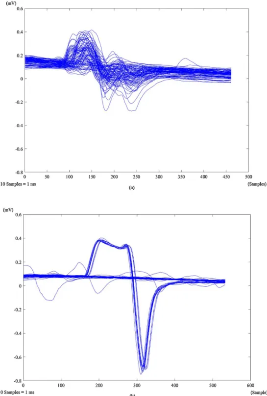 Fig. 6. Superimposed F-Wave Traces of a Healthy Volunteer (a) and an ALS Patient (b).