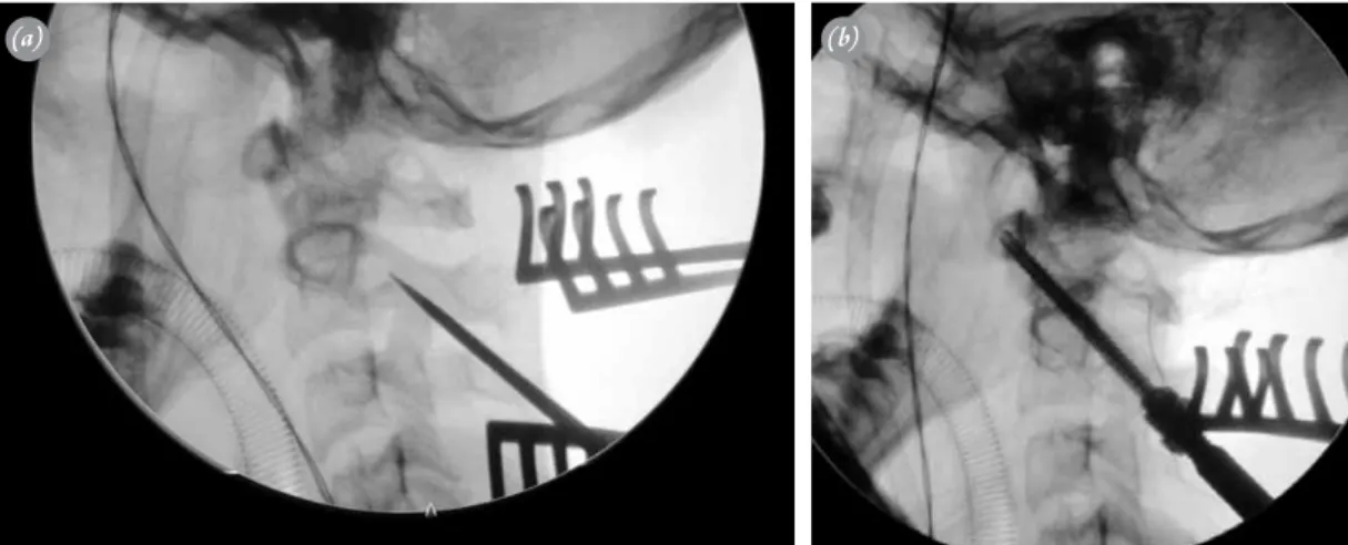 Şekil 3.  (a) Ameliyat sırasındaki skopi görüntüsü; laminalar ipekle bağlandıktan sonra dislokasyonun düzeldiği ve vidalama  işleminin güvenle yapıldığı görülmekte