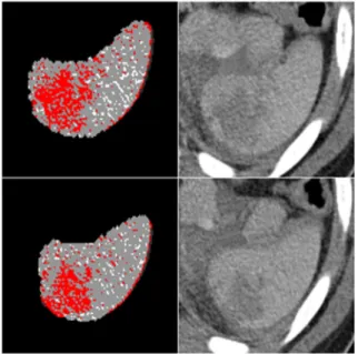 Figure 3: Subtracting the original segmented splenic volume  from the enlarged spleen (fourteen voxels in x and y Cartesian  coordinates, one voxel to above the spleen and four voxels to  under the spleen) revealed the perisplenic region