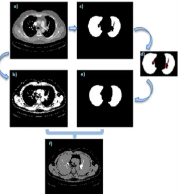 Fig. 2. Segmental and subsegmental vessel segmentation: (a) – the original 2D  image; (b) – threshold  image by taking  vessels; (c) – segmented  2D lungs  without  their  vessels; (d) – adding  vessels  on  the  lungs; (e) – segmented  lung  with  their  