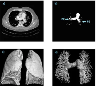 Fig. 3. The  original  2D  image (a); Segmented  2D  lung  vessels  with  PEs (b); Segmented 3D lung (c); Segmented 3D lung vessels with all branches (d).
