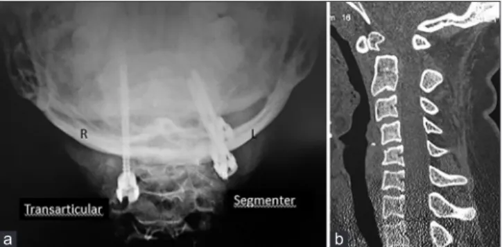 Figure 2: Postoperative direct X-ray posterior-anterior (a) and  coronal computed tomography (b) imaging of the upper cervical  spine showing both segmental and transarticular screws