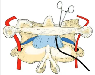Figure 4: The illustration imaging of the C1-C2 spine showing an  auto graft harvested from iliac crest was tightened with sutures  of number 0 silk thread over spiral sutures passing under laminae  between laminae of decorticated C1 and C2 and posterior  