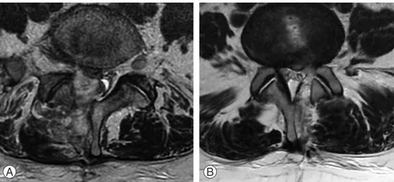 Fig. 2. (A)  T2 -weighted axial magnetic resonance imaging showing hematoma formation (group B) at the epidural  space between L4 and L5, one day postoperative