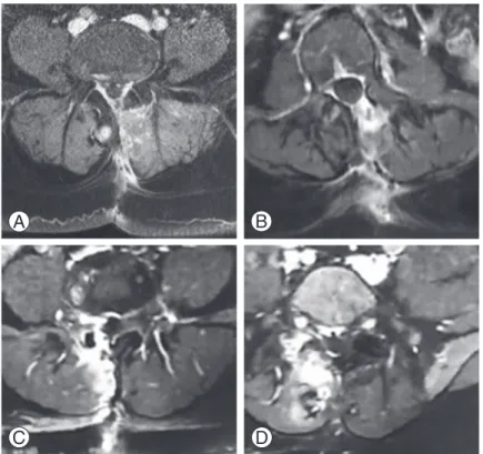 Fig. 3.  The grading system of epidural fibrosis with T1 weighted axial magnetic reso- reso-nance imaging in postoperative period (12 months):  (A)  grade 1;  (B)  grade 2;  (C)  grade 3;  and  (D)  grade 4