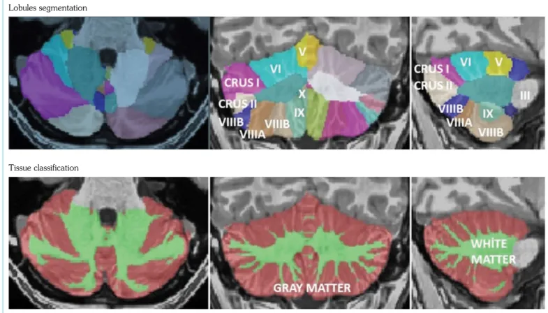 Figure 4.  (a) MRICloud-ImageJ Bland-Altman graphic. (b) MRICloud-VolBrain Bland-Altman graphic