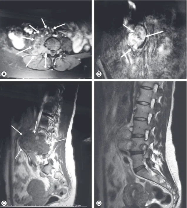 Fig. 1. (A)  T2 -weighted axial image showing a giant dumb-bell-shaped mass extending anteriorly