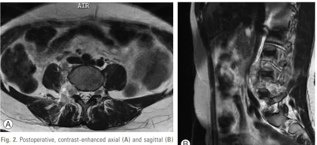 Fig. 3.  After complete excision and skin closure.