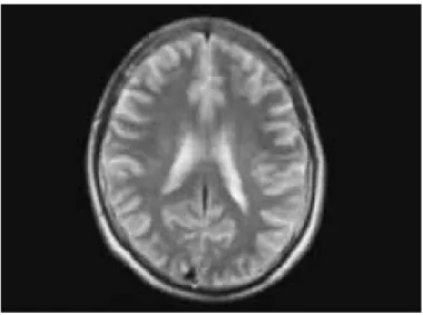 Figure 1b.  Magnetic resonance imaging (MRI) image of lesion regions  with multiple sclerosis (MS)