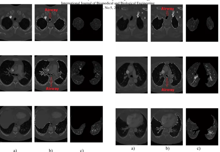 Fig. 7 a) Original CTA image   b) Identified edges of airway and  lung c) Accurate segmented lung 